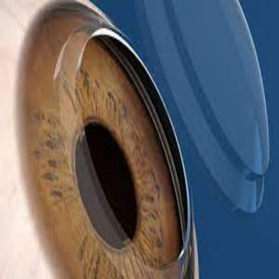 Glaucoma Treatment